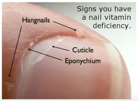 2018 – nails and biotin deficiency - H Pylori Symptoms