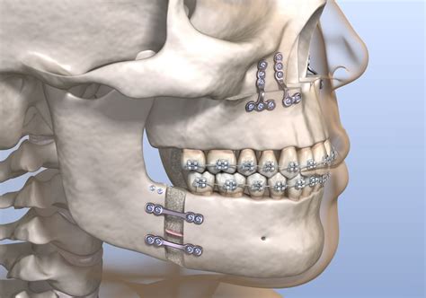 What Is Double Jaw Surgery? Your Top Questions Answered | Jaw Surgery LA