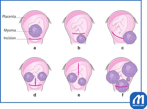 (a) Lower transverse incision. (b) Lower transverse incision at a ...