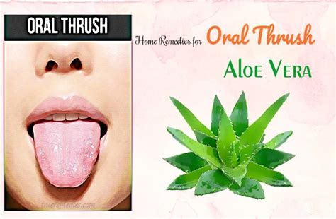 13 Home Remedies For Oral Thrush In Babies And Adults