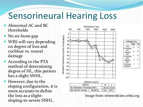 Audiogram interpretation