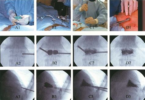 Kyphoplasty treatment performed at L1 level. Sequential intraoperative... | Download Scientific ...