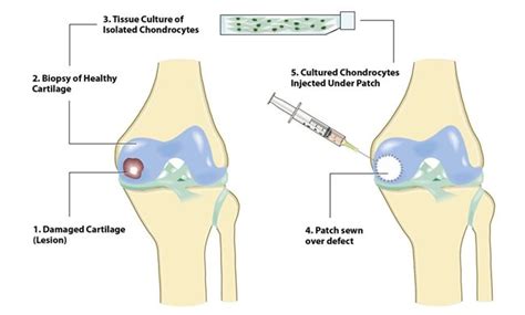 Cartilage Cell Transplantation - RJAH