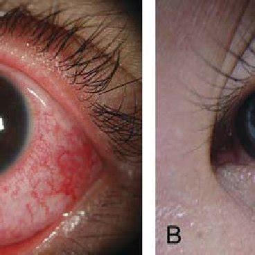 Demographic Profile and Clinical Features of Patients With Autoimmune ...