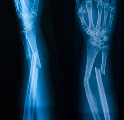 Xray Image Of Broken Forearm Ap And Lateral View Stock Photo - Download Image Now - iStock