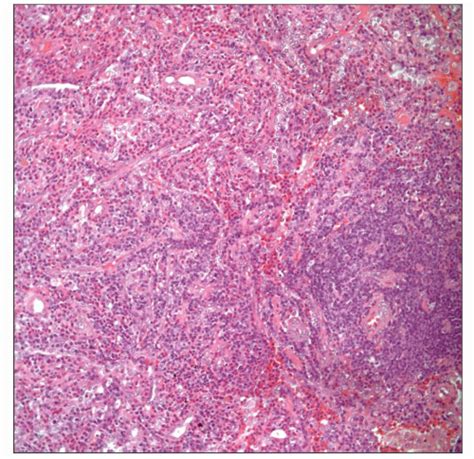 Angiolymphoid Hyperplasia with Eosinophilia | Basicmedical Key