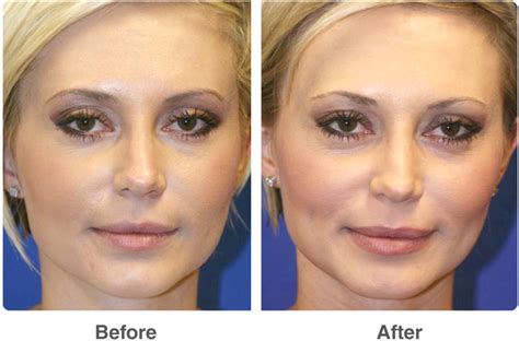 Laser Skin Resurfacing - Patient 2 | Individual results may vary