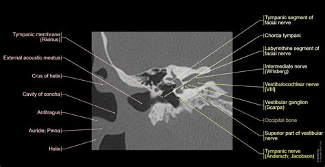 Petrous bone CT: normal anatomy | e-Anatomy