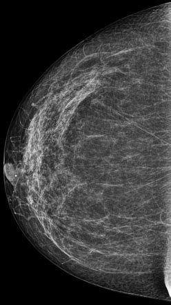 Normal mammography: scattered areas of fibroglandular density ...