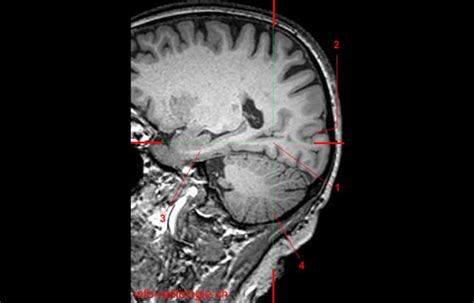 The Occipital Lobe - W-Radiology