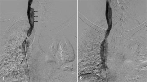 Superior vena cava (SVC) stenting: (a) Right internal jugular venogram... | Download Scientific ...