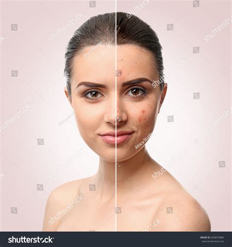 Woman Face Before After Acne Treatment Stock Photo 603810884 | Shutterstock