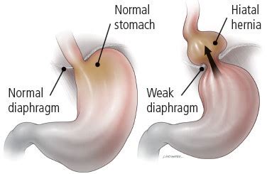 What is a hiatal hernia? - Harvard Health