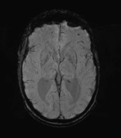 Neurosyphilis Mri