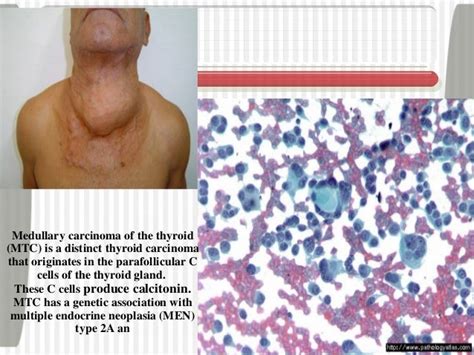 thyroid tumor