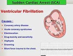 20 Ventricular Fibrillation ideas | cardiac rhythms, heart electrical ...