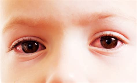 Common eye conditions in kids