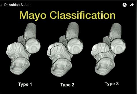 Coronoid Process Fracture Fixation — OrthopaedicPrinciples.com