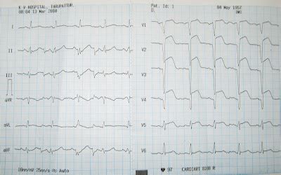 Medical Images Gallery: Anterior Wall MI Reinfarct ECG Changes