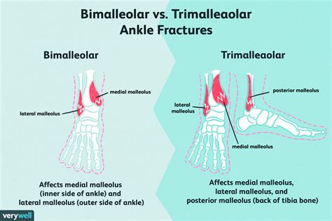 Bimalleolar and Trimalleolar Ankle Fractures