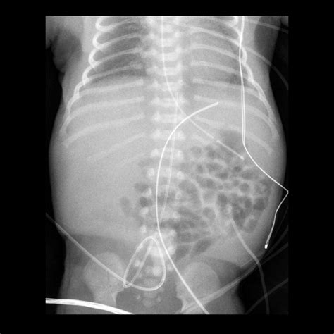 Premature newborn status umbilical venous catheter placement | Pediatric Radiology Case ...