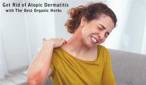 Get Rid of Atopic Dermatitis with Herbal Remedies