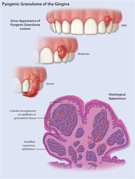 A Case of Recurrent Pyogenic Granuloma of Gingiva | HealthPlexus.net