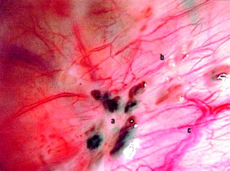 What Are The Stages Of Endometriosis Endometrial Implants