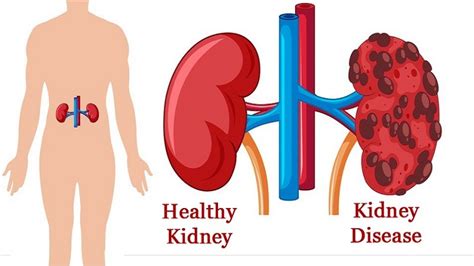 Kidney Diseases, Types and Diagnosis - Helal Medical