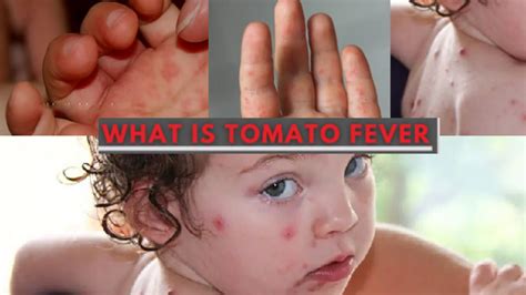 What is Tomato Flu or Tomato Fever? Symptoms | Causes | Prevention