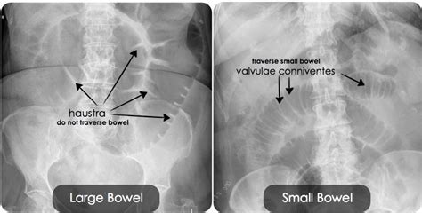 It is often difficult to decipher large bowel from small bowel on an X-ray. The air-filled large ...