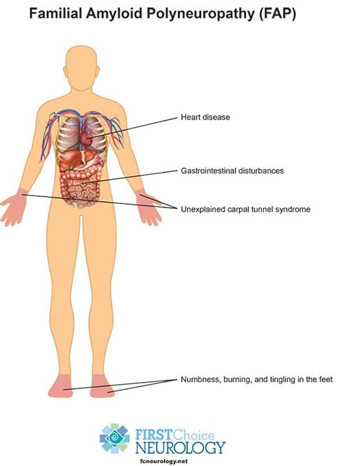 Familial Amyloid Polyneuropathy - Causes, Treatment, Transthyretin, FAP