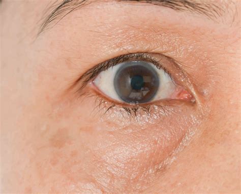 Puffy Eyes: Symptoms, Causes, and How to Get Rid of Them