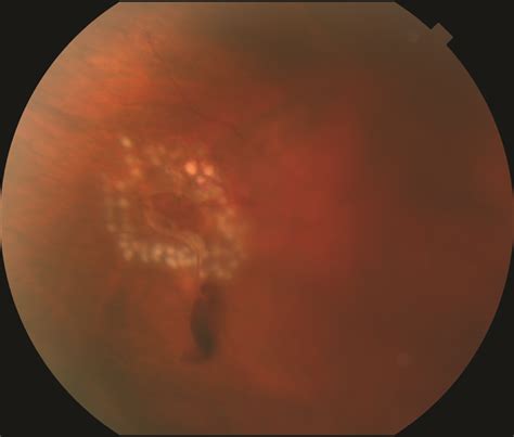 Figure 1. Laser photocoagulation around retinal tear with small ...