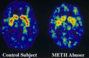 Why the Myth of the Meth-Damaged Brain May Hinder Recovery | TIME.com