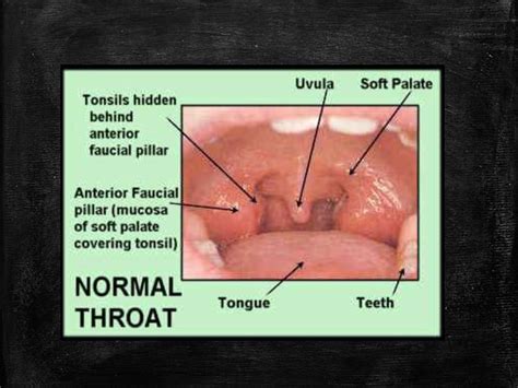 White patch on the tonsil – differential diagnosis