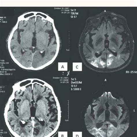 (PDF) Bilateral Cortical Blindness due to Bilateral Occipital Infarcts without Anosognosia