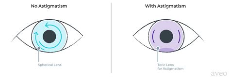 Can I Wear Contacts with Astigmatism? | by Aveo Vision | The Wink | Medium