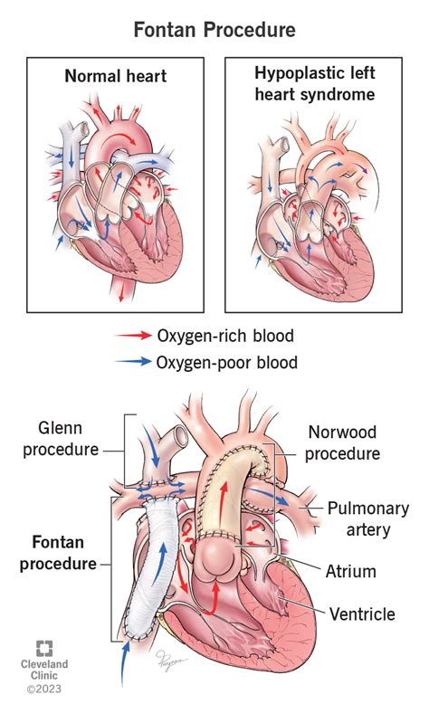 Fontan Procedure: Details & Outlook