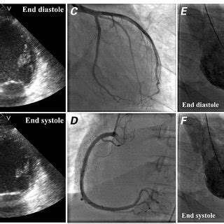 Global Lv Hypokinesia With Regional Variation - QLABOL