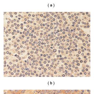 Immunohistochemical stains of lymphoma tissues (a) negative, (b ...