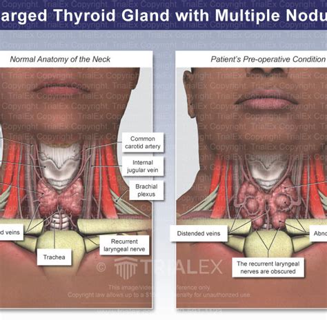 Enlarged Thyroid Gland with Multiple Nodules - TrialQuest Inc.