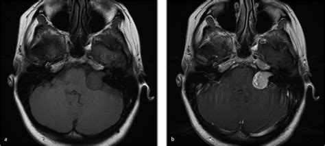 25 Tumors of the Cerebellopontine Angle | Neupsy Key