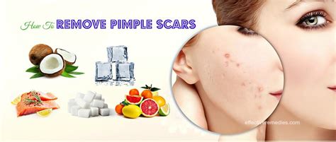 20 Ways How To Remove Pimple Scars From Face, Cheeks & Forehead