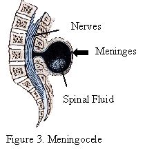 Spina Bifida - Meningocele Spina Bifida