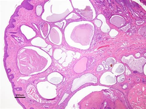 Dermal Duct Tumor Histology