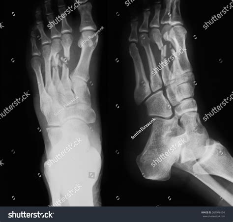 X-Ray Image Of Foot, Ap And Oblique View, Show Fracture Of The Second And Third Metatarsal Bones ...