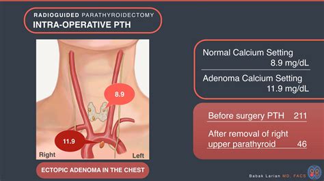 Radioguided parathyroidectomy intra-operative PTH Ectopic adenoma in ...