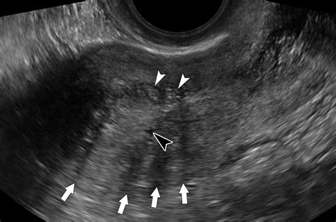 Endometrioma Ultrasound