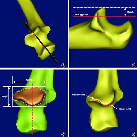 Coronoid process reconstruction and anatomical parameters definition ...